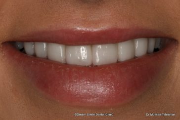 After Case 25 Veneers