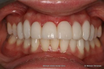 After Case 06 Gum Contouring