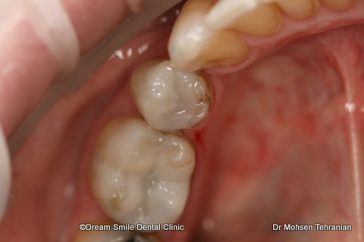 After Case 08 Fillings