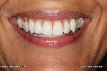 After Internal whitening single tooth