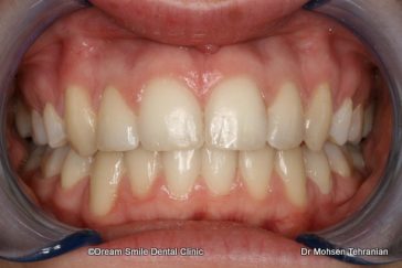 After Six Month Smile Case 02