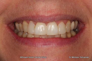 After Laser Gum Contouring 1