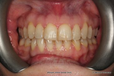 After Six Month Smile Case 03