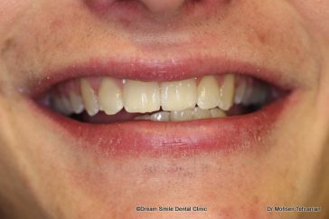 After Six Month Smiles Case 01