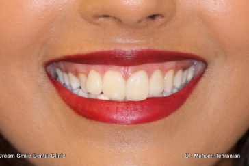 After Gum Bleaching of dark gums