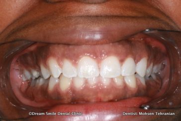 After Whitening After Invisalign