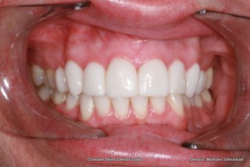 After 10 Upper Emax veneers ,