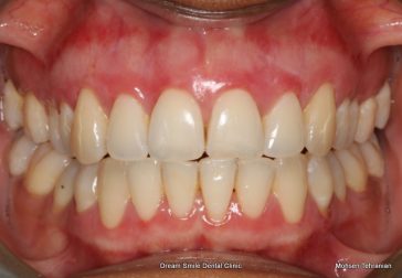 After Gum Depigmentation