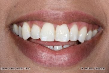 After Laser gum whitening 16