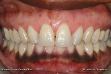 After Gum Whitening case 17