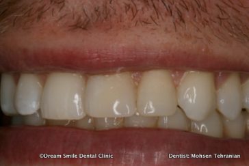 After 2 Composite fillings replaced