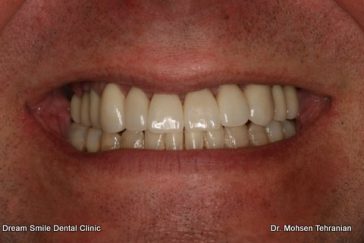 After Full Mouth reconstruction veneers