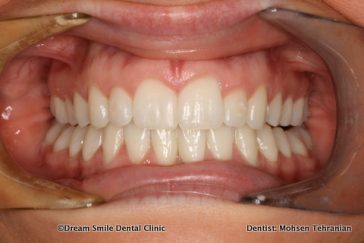 After Invisalign, Whitening, Composite bonding