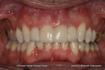After Combination Invisalign and crowns