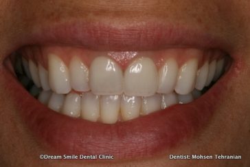 After 2 Porcelain Veneers