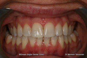 After Case 20 Invisalign