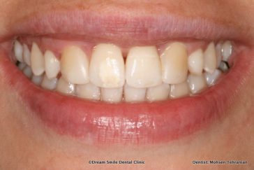 After Invisalign then composite bonding