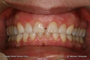 After Gum Bleaching Case 1 Smile