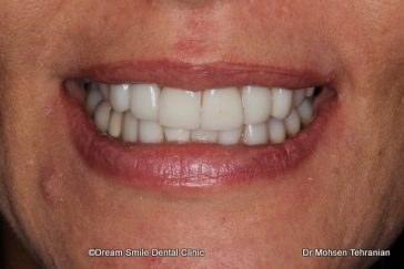 After Case 26 Composite Veneers