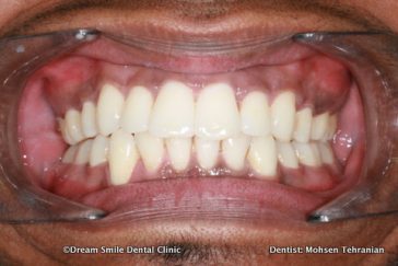 After Whitening after Invisalign