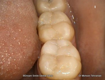 After Case 05