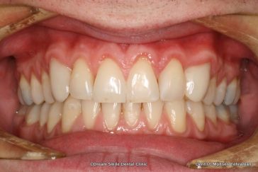 After Composite Bonding and 2 Emax Crowns