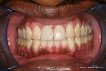 After Combination of Invisalign and Implant