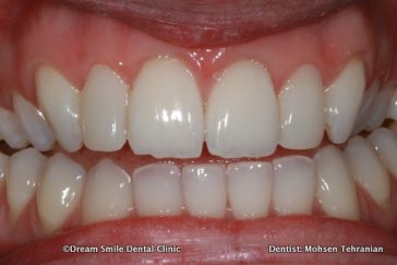 After 2 Composite Veneers