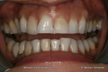 Before Case 26 Composite Veneers