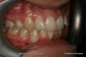 Before Six Month Smile Case 02