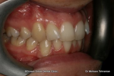 Before Six Month Smile Case 02