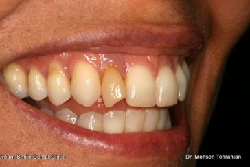 Before Internal whitening single tooth and composite bonding
