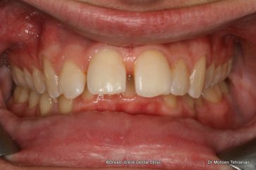 Before Six Month Smiles Case 02