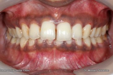 Before Gum Depigmentation laser