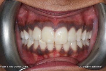 Before Gum Bleaching of dark gums