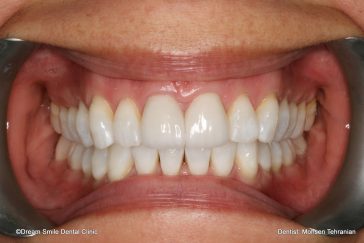 After Combination of whiteing and 2 e-max veneers