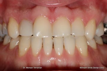 After composite veneers to close gappy teeth