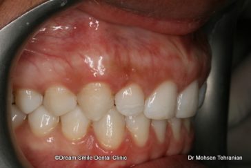After Case 19 Invisalign