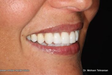 After Internal whitening single tooth and composite bonding