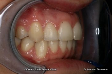 After Six Month Smile Case 02