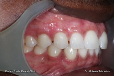 After Dark Gum Pigmentation