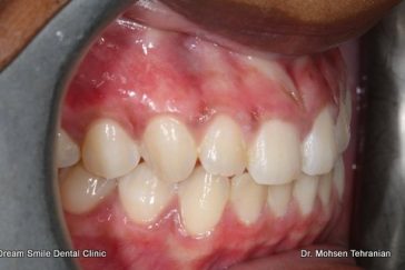 After Gum Bleaching