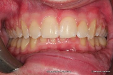 After Six Month Smiles Case 02