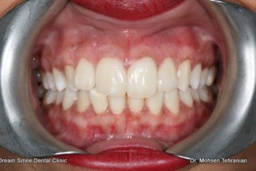 After Gum Bleaching of dark gums