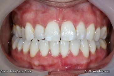 After Laser gum whitening 16