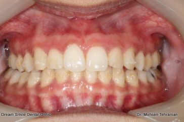 After Laser gum whitening  15