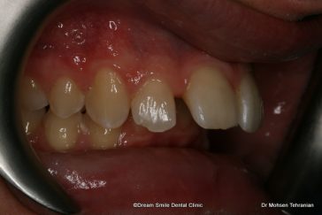 Before Six Month Smiles Case 02