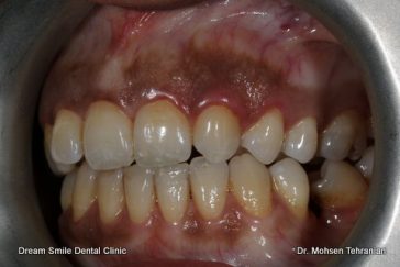 Before Case 06 Gum Bleaching