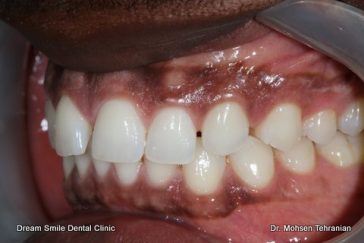 Before Dark Gum Pigmentation