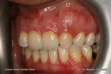 After Case 06 Gum Bleaching